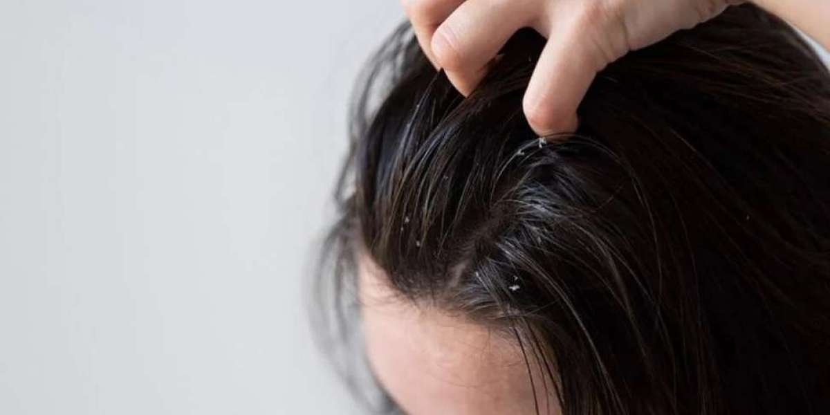 Causes that can cause dandruff