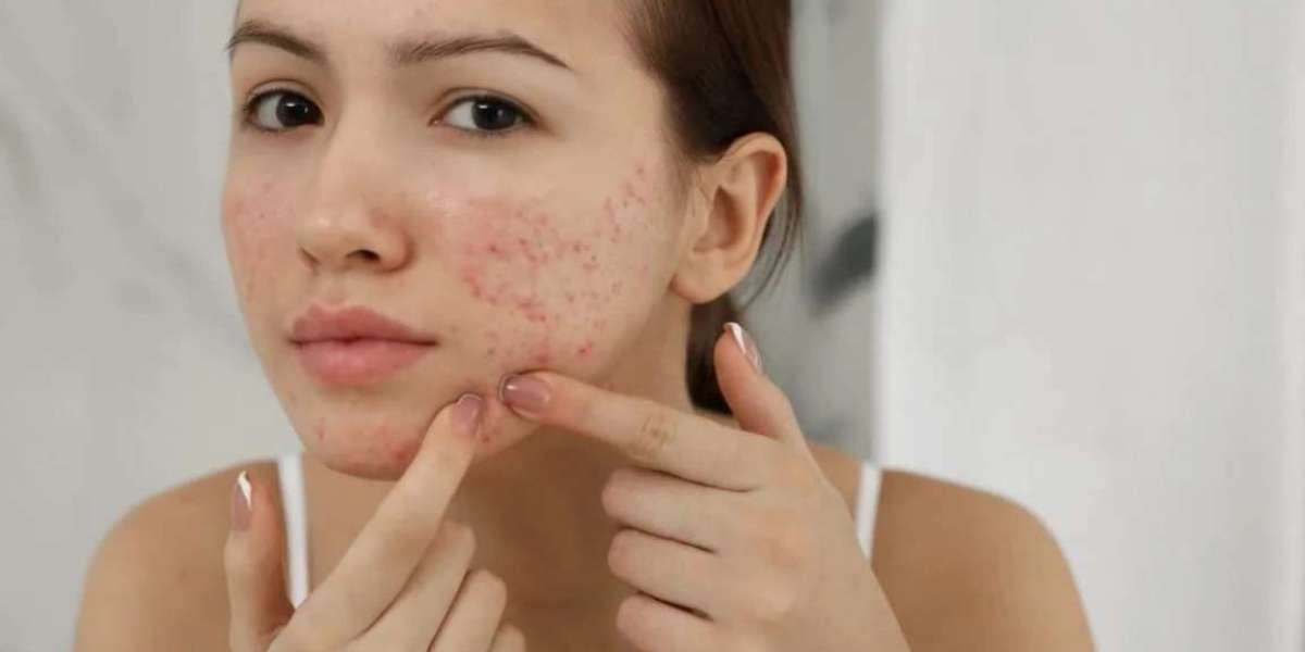 What to do to reduce acne