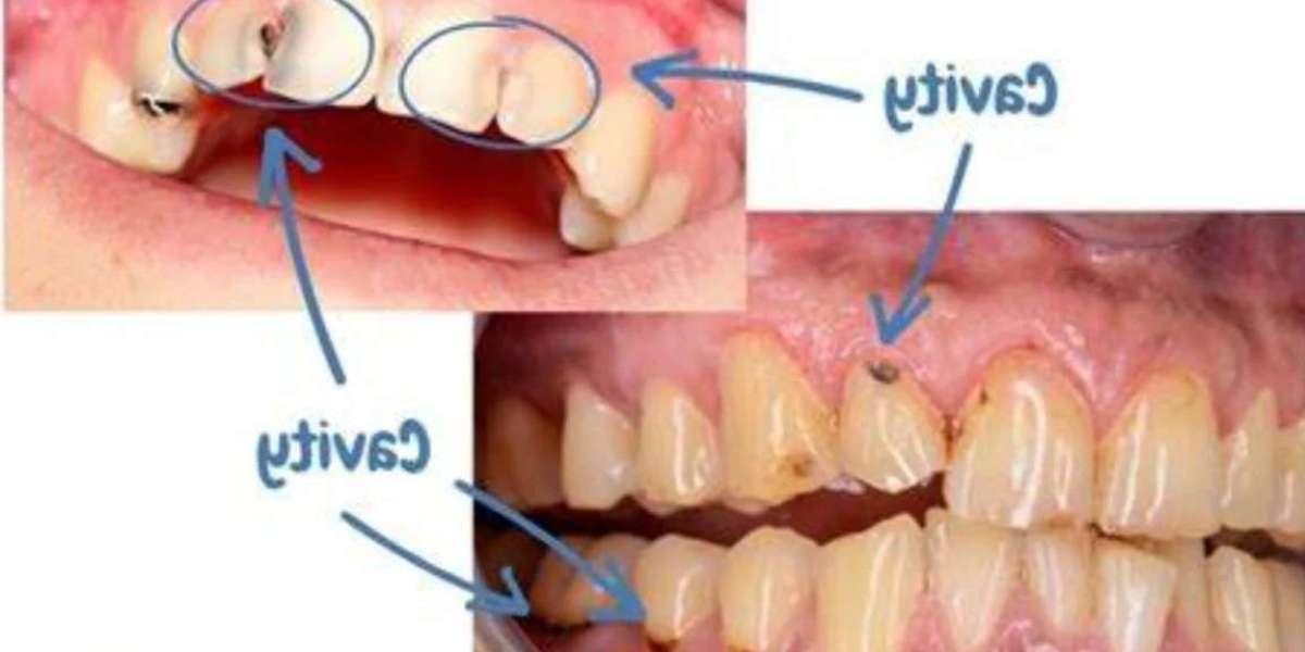 Simple rules to avoid cavities or enamel erosion