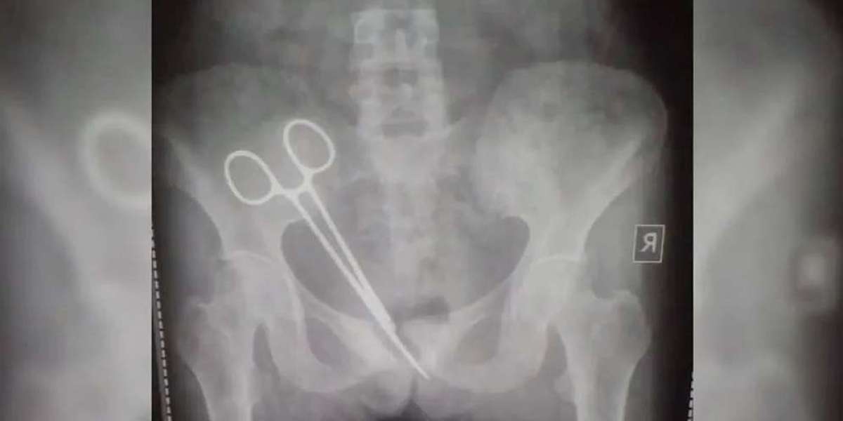 In the hospital with stomach pain, scissors came out of the stomach