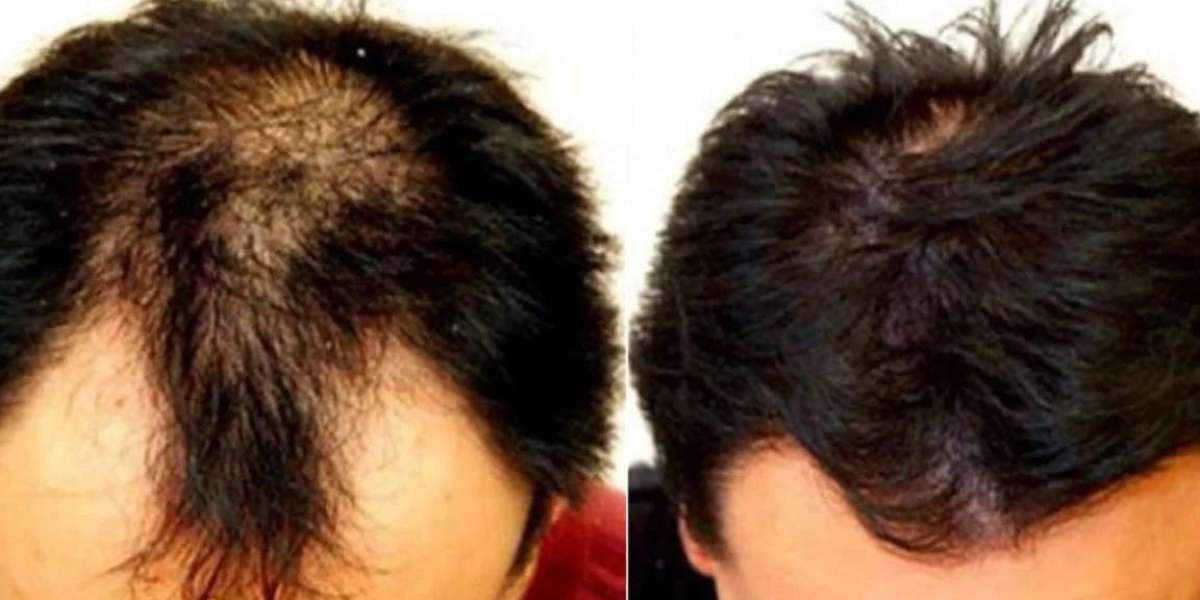 This mixture will grow hair like magic at home