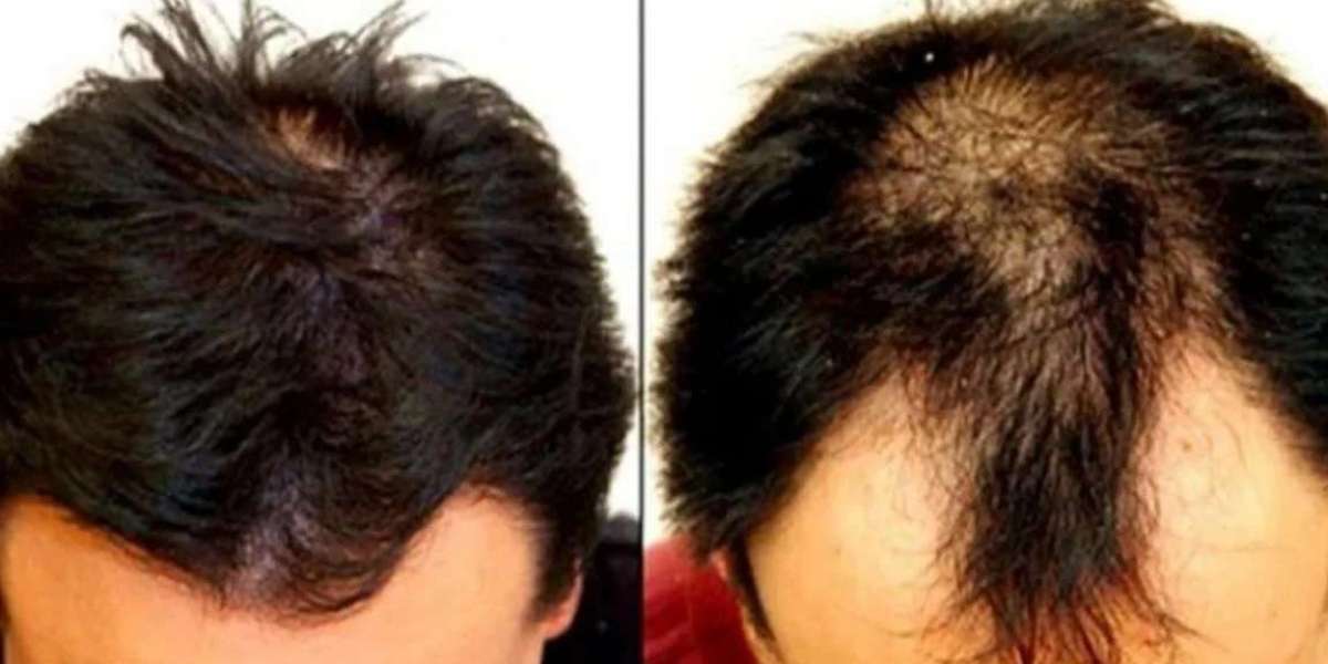 A great way to grow new hair on the head, which many people do not know