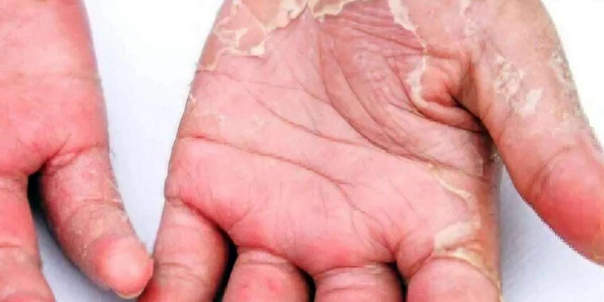 What to do to stop the skin of the palms of the hands and feet