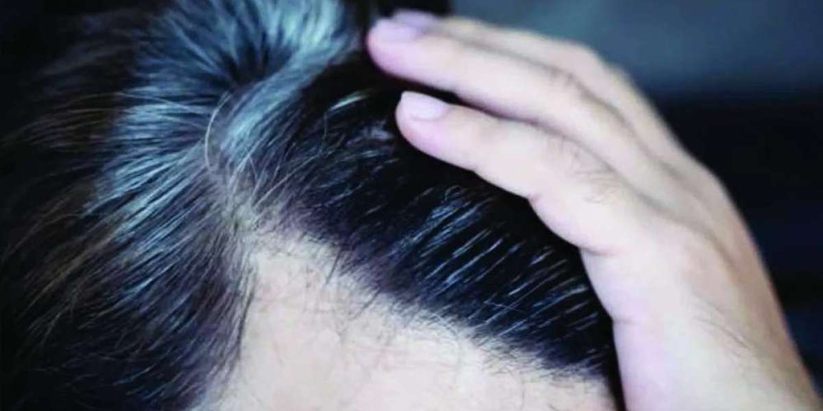 Ways to stop hair graying at an early age